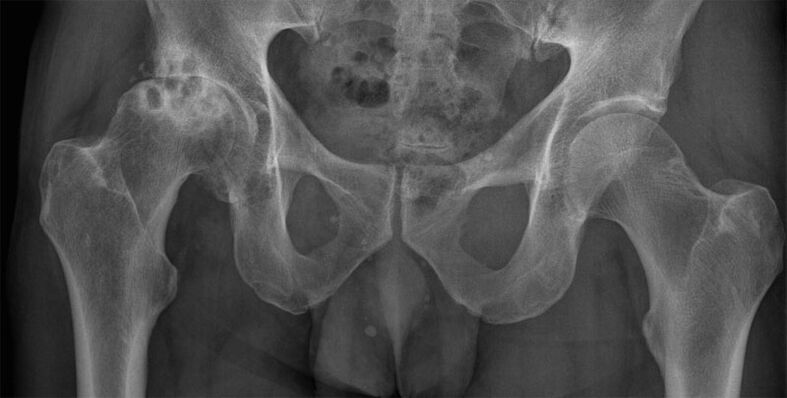 Рентгенограммада жамбаш муунунун 3-этап артрозы