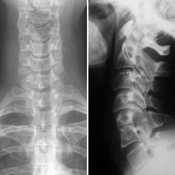 Моюнчанын омурткасынын x -Ray